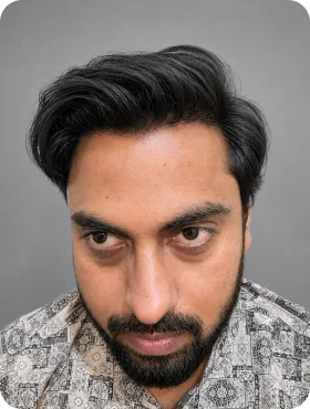 Patient hairline recovery status after treatment